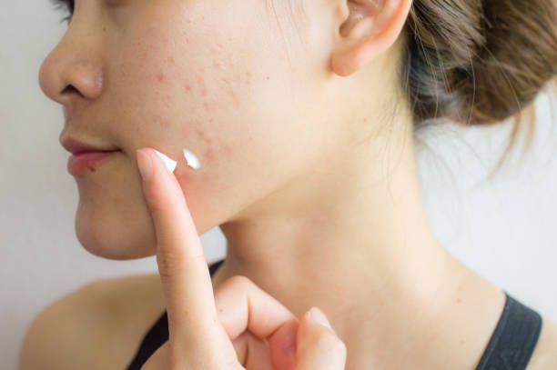 Popping Pimples vs Professional Extractions